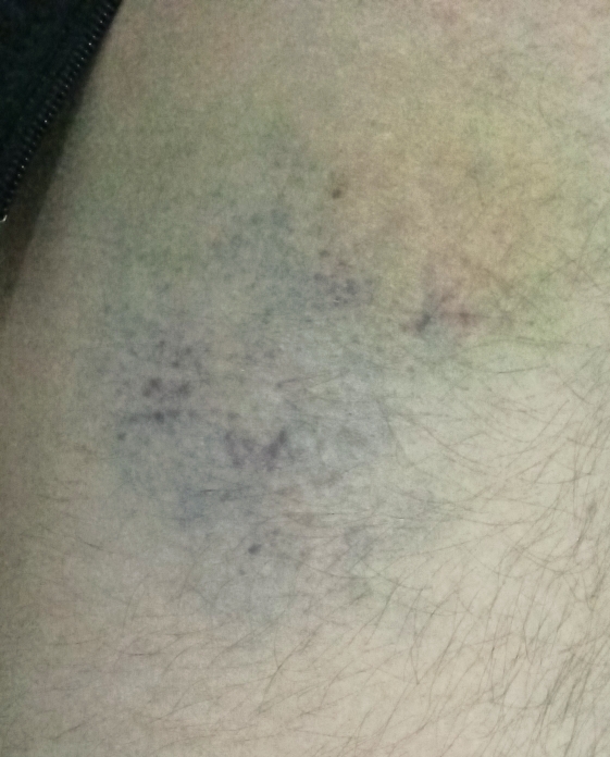 Black, purple, and yellow bruising on the outside of my right thigh from falling and sliding down a flight of stairs.